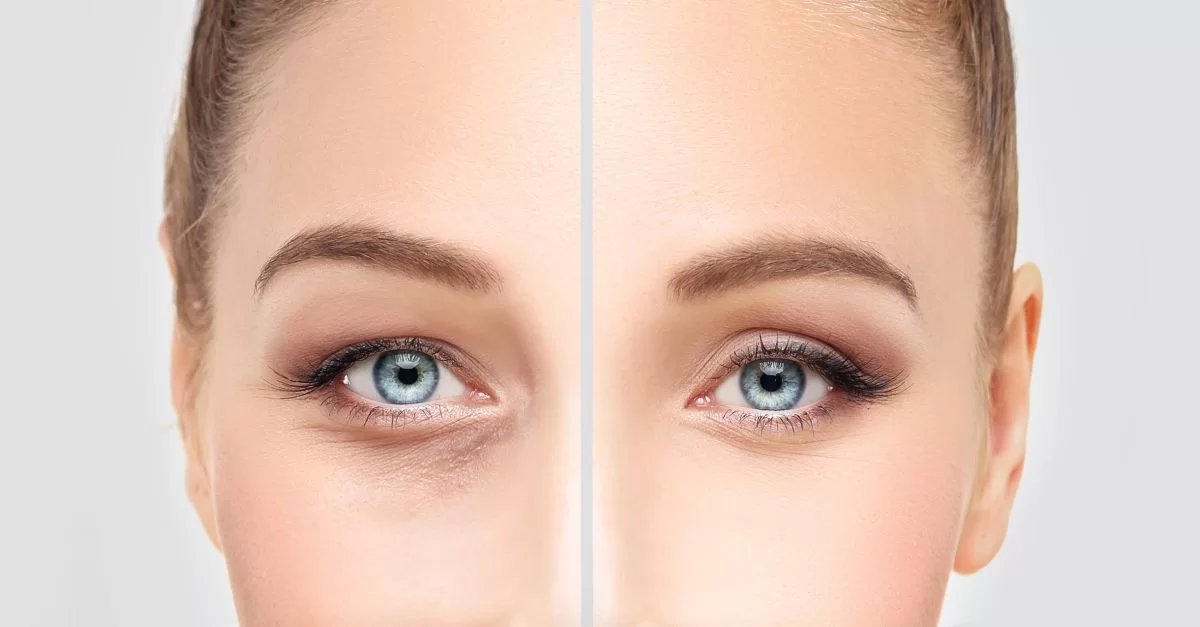 mituri-blefaroplastie