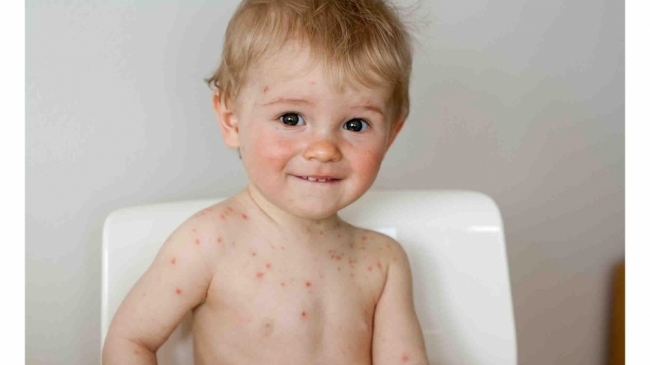Cum tratezi o alergie la copiii
